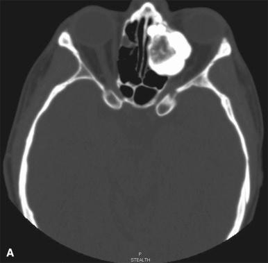 Figure 40.11, Sino-Nasal Osteoma With Osteoblastoma-Like Foci.