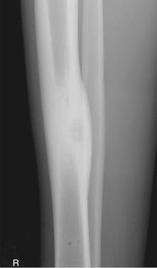 Figure 40.12, AP radiograph of an osteoid osteoma of the tibia. The radiolucent central nidus is surrounded by dense, reactive bone.