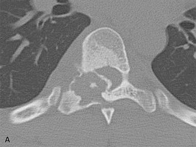 Figure 40.14, Osteoblastoma of the Spine.