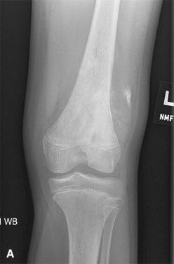 Figure 40.15, Radiographic Features of Conventional Osteosarcoma of the Distal Femur.