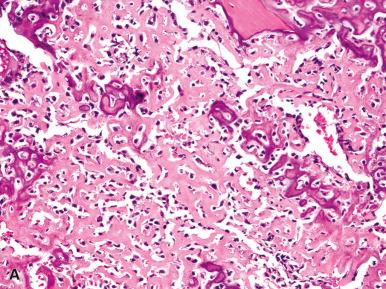 Figure 40.17, Main Histologic Variants of Conventional Osteosarcoma.