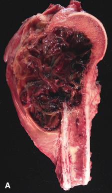 Figure 40.18, Telangiectatic Osteosarcoma.