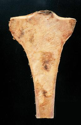 Figure 40.19, Gross appearance of low-grade central osteosarcoma of the tibia.