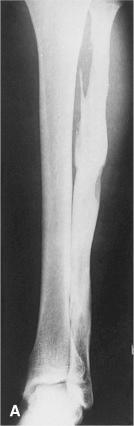 Figure 40.2, Two Examples of Chronic Osteomyelitis Involving the Fibula.