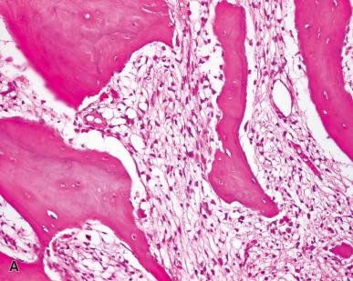 Figure 40.21, Parosteal Osteosarcoma.