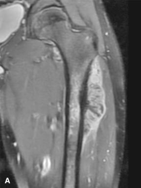 Figure 40.22, A, MRI and B, gross features of periosteal osteosarcoma. The lesion arises from the surface of the proximal femoral metadiaphysis, and the cut surface is cartilaginous and contains reactive bone oriented perpendicular to the femoral surface.