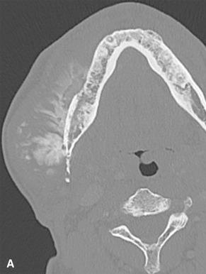 Figure 40.23, A, CT and B, gross features of osteosarcoma of the jaw. C, Most gnathic osteosarcomas are of the chondroblastic variety.