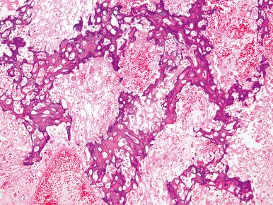 Figure 40.24, When treated with neoadjuvant chemotherapy, susceptible osteosarcomas show dropout of viable tumor cells (“necrosis”), but the osteoid matrix persists.