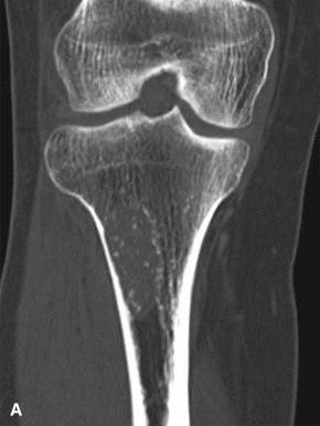 Figure 40.25, A, Coronal-plane CT shows a circumscribed metaphyseal enchondroma with stippled calcifications. B, Histologically, enchondromas are composed of lobules of mature hyaline cartilage which are partially or complete encompassed by bone.