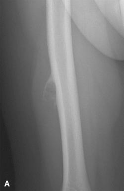 Figure 40.27, A, Radiographic and B, CT features of periosteal chondroma. This small, surface-based cartilage lesion is often partially covered by reactive bone from the overlying periosteum, and causes erosion of the underlying cortex. C, Periosteal chondromas are composed of mature hyaline cartilage and covered by periosteum.