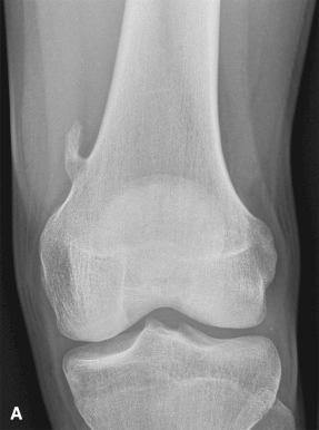 Figure 40.28, A, Radiograph showing a pedunculated osteochondroma arising from the distal femoral metaphysis and pointing away from the knee joint. B, Grossly, this osteochondroma was covered by only a thin cartilage cap and was complicated by the formation of a bursa.