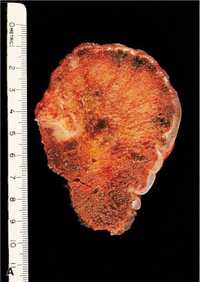 Figure 40.29, A and B, Gross and whole-mount appearance of osteochondroma. Mature bone is covered by a well-differentiated cartilaginous cap.