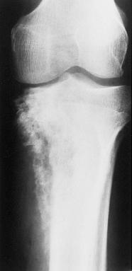 Figure 40.3, Gummatous involvement of tibia in a 45-year-old woman.