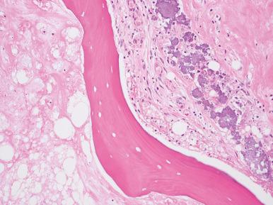 Figure 40.4, Bone necrosis is characterized by loss of osteocytes and necrosis or fibrosis of the fatty marrow.