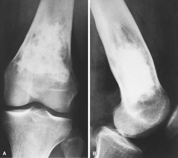 Figure 40.5, AP (A) and lateral (B) radiographs show a large metadiaphyseal bone infarct of femur. The irregular area of increased radiodensity is indicative of new bone production superimposed on necrosis.