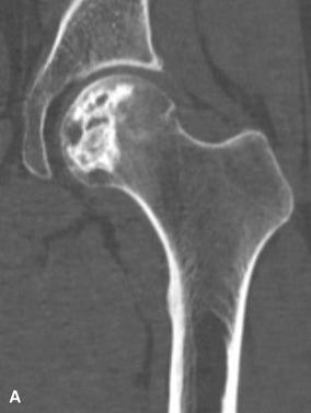 Figure 40.6, A, Coronal CT shows a discrete area of subchondral density with cystic change, indicative of avascular necrosis. B, A discrete area of avascular necrosis, which appears yellowish on cut section. Separation of the articular cartilage and subchondral bone is characteristic. C, The infarct is contained by a hypervascular reactive zone. The separation of the articular cartilage and subchondral bone is evident histologically.