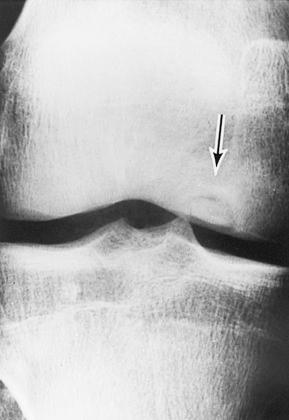 Figure 40.7, Sharply delimited area of osteochondritis dissecans of medial condyle (arrow) . This was easily enucleated.