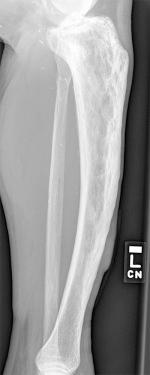 Figure 40.8, Radiograph of Paget disease involving the tibia. Both cortical thickening and coarsening of the cancellous bone is accompanied by an anterior bowing deformity.