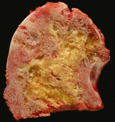 Figure 40.9, Paget disease involving the femoral head. There is marked deformity of the femoral head with coarsening of the bone, as well as secondary osteoarthritis.