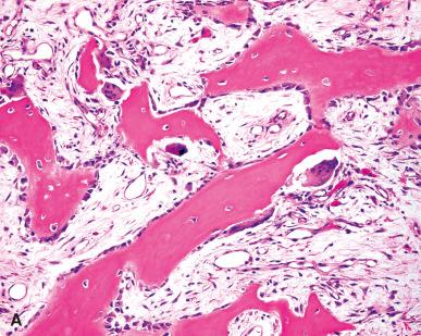 Figure 40.10, Paget Disease.