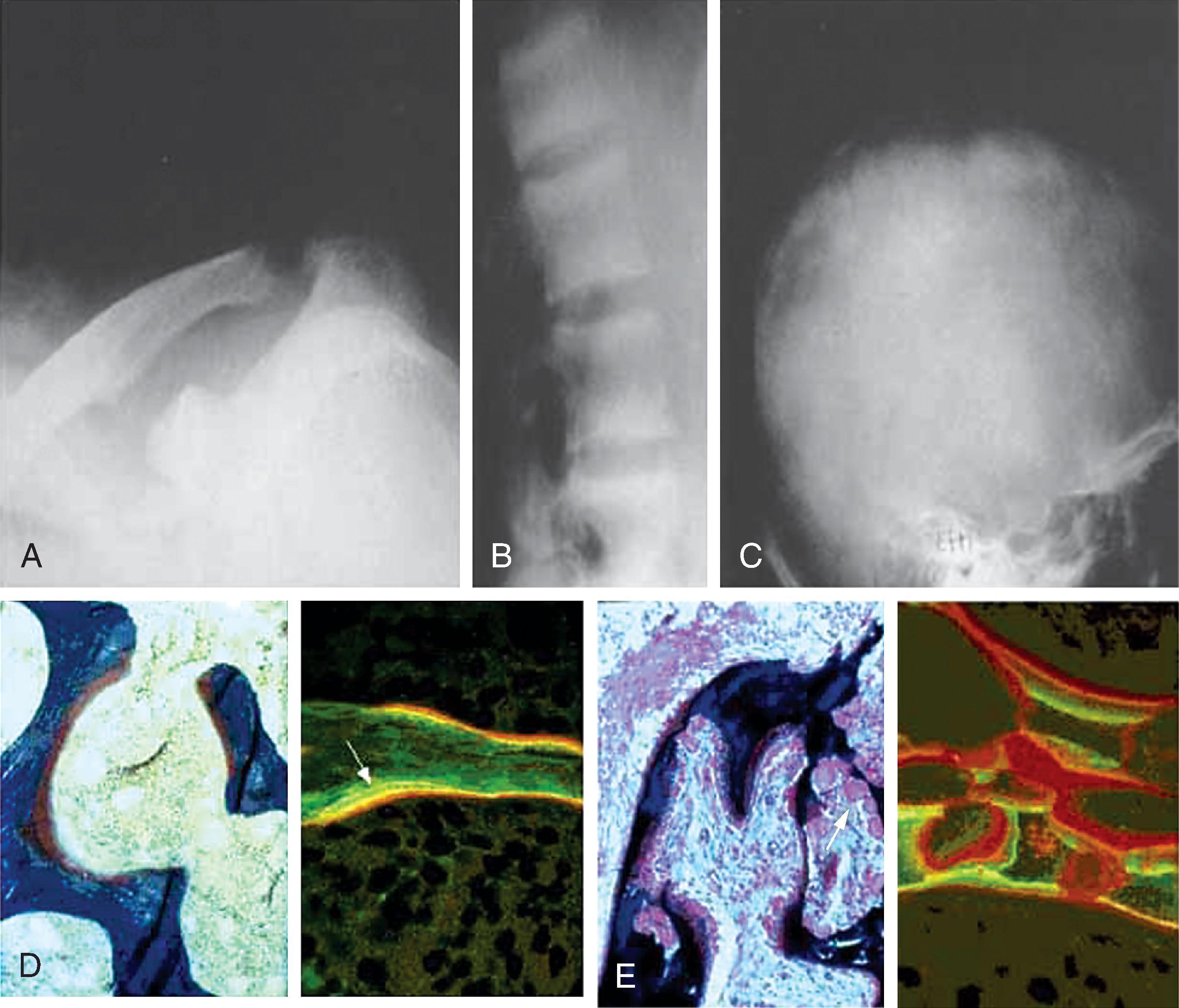 Fig. 53.2, Radiographic and histologic features of bone disease associated with chronic kidney disease (CKD). (A) Radiographic findings of severe erosion of the distal clavicle resulting from secondary hyperparathyroidism. (B) Example of “rugger-jersey spine” resulting from sclerosis of the end plates associated with hyperparathyroidism. (C) “Pepper-pot skull” with areas of erosion and patchy osteosclerosis associated with hyperparathyroidism. (D) Histologic appearance of normal bone. On the left, a section stained with Goldner Masson trichrome stain shows mineralized lamellar bone (blue) and adjacent nonmineralized osteoid surfaces (red-brown) . On the right, a Villanueva-stained section viewed under fluorescent light shows tetracycline labeling of freshly formed bone. Double staining (arrow) indicates amount of new bone laid down during the interval between the two periods of tetracycline administration. (E) Histologic appearance of osteitis fibrosa in a patient with CKD stage G5 and elevated parathyroid hormone levels. On the left, Goldner Masson trichrome stain shows increased numbers of multinucleated osteoclasts at resorptive surfaces (white arrow) and extensive bone marrow fibrosis (light-blue staining of marrow). On the right, tetracycline labeling shows marked increases in the osteoid (orange-red staining) and in sites of new bone formation as measured by the yellow-green bands below the osteoid surfaces. (A–C from Martin KJ, Gonzalez EA, Slatopolsky E. Renal osteodystrophy. In: Brenner BM, ed. Brenner and Rector’s the Kidney . 7th ed. Philadelphia: Saunders; 2004:2280.)