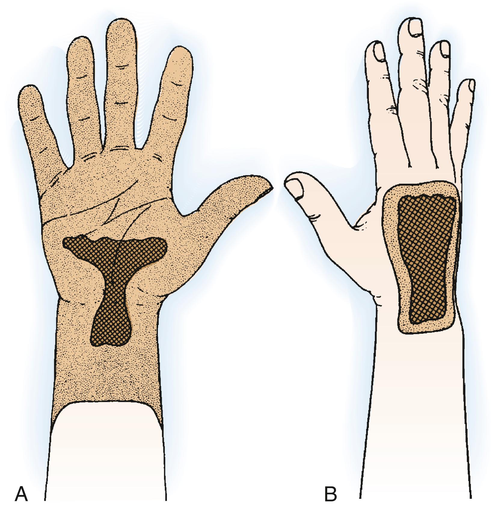 Fig. 59.11, A, Tumors on the proximal volar aspect of the palm often involve the flexor tendons and median and ulnar nerves; forearm- or wrist-level amputation is usually required. B, Lesions on the dorsum of the hand may not necessarily invade vital neurovascular structures and can be adequately resected en bloc, followed by secondary reconstruction.