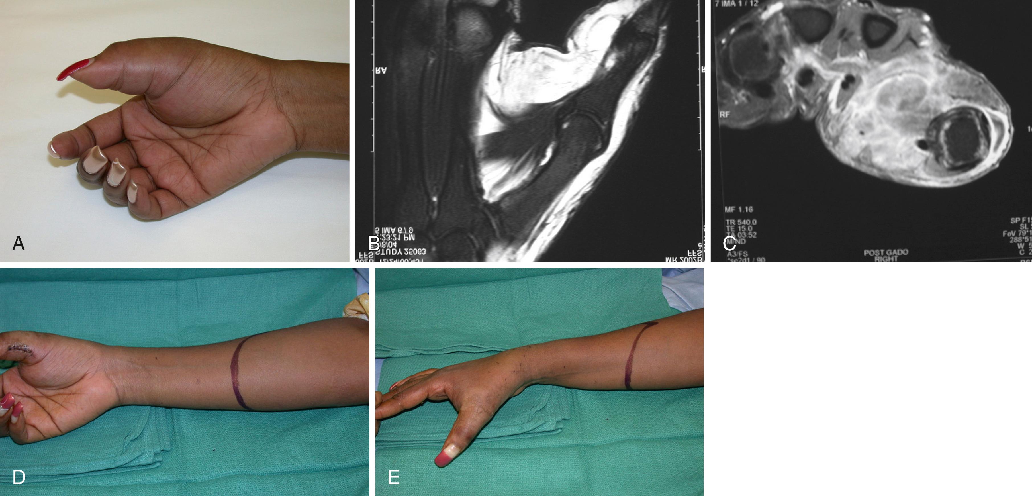 Fig. 59.12, A to C, A myxofibrosarcoma of the thumb with extensive infiltration into the hand rendering hand salvage impossible. D and E, The patient was treated by below-elbow amputation.