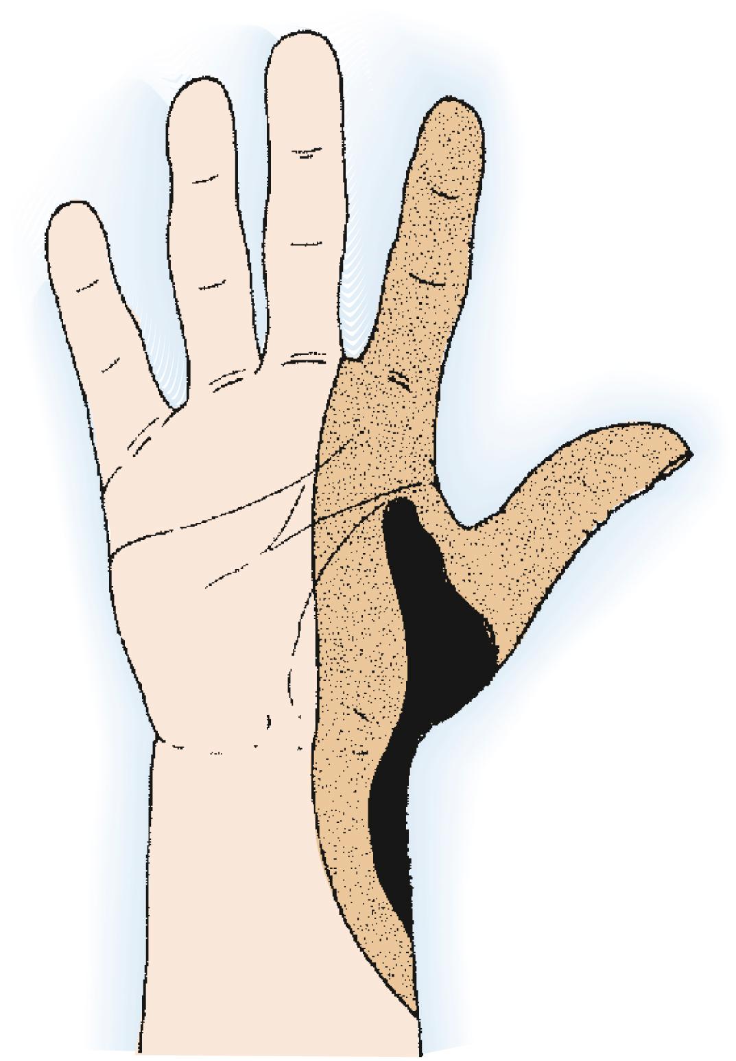 Fig. 59.13, Aggressive tumors of the radial side of the distal part of the forearm may require amputation of the thumb and index rays, as well as the contiguous radial side of the wrist at a minimum.