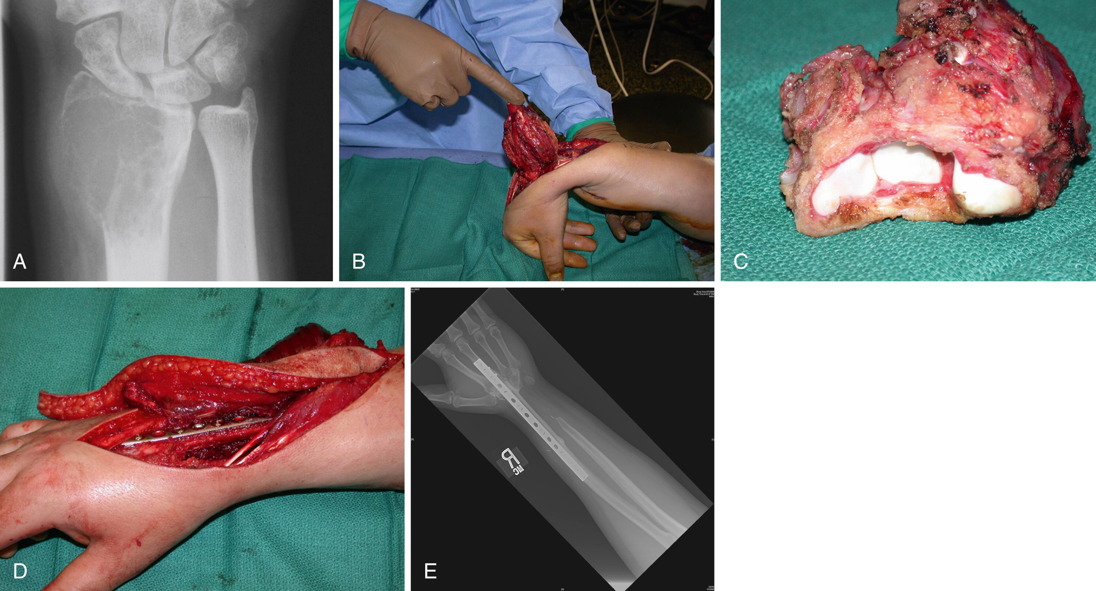 Fig. 59.14, A, Radiograph of giant cell tumor of bone involving the distal radius. B, Radius and ulna have been transected and entire segment is everted to facilitate volar dissection. C, Extraarticular resection is completed by disarticulating at the midcarpal joint. D, Intercalary arthrodesis is performed using a vascularized osteoseptocutaneous fibula. E, Radiograph following healing.