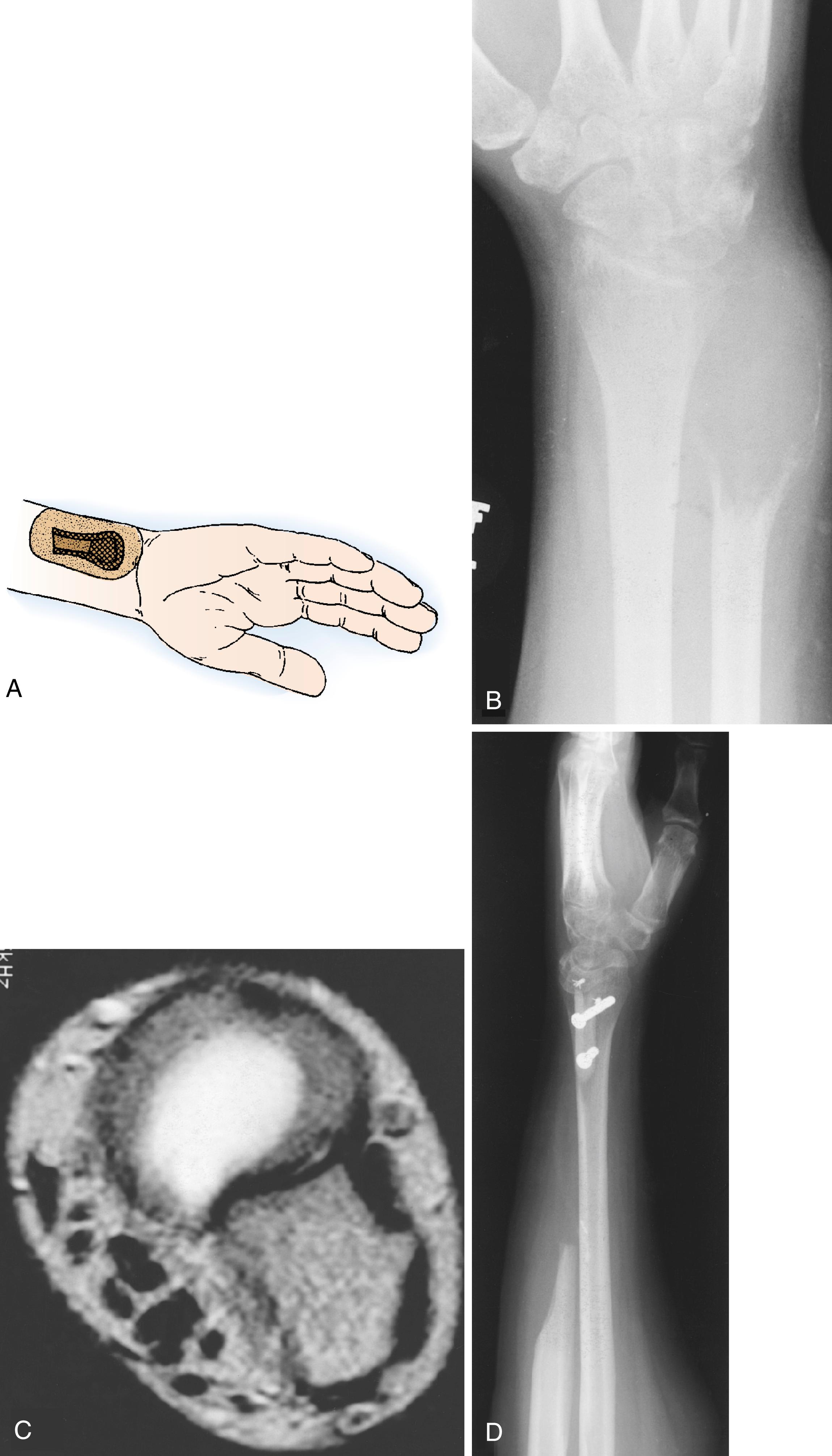 Fig. 59.15, A, Intraosseous tumors of the distal ulna can be managed by en bloc excision. No bone reconstruction is needed in most cases. Tumors with soft tissue extension ( B and C ) may require excision of the ulnar cortex of the radius en bloc with the ulna, as was required with this malignant fibrous histiocytoma. D, A portion of the remaining ulna was used to augment the radius and support the lunate facet.