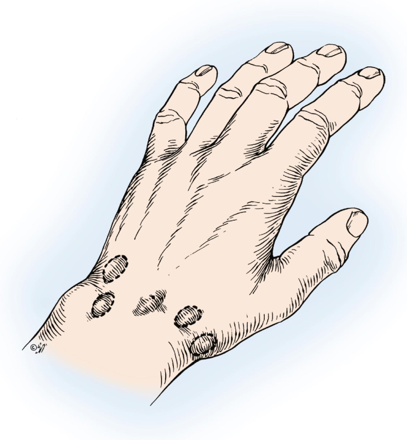 Fig. 59.16, A few of the many possible locations of dorsal wrist ganglions. The most common site is directly over the scapholunate ligament. The others (dashed circles) are connected to the scapholunate ligament through an elongated pedicle.