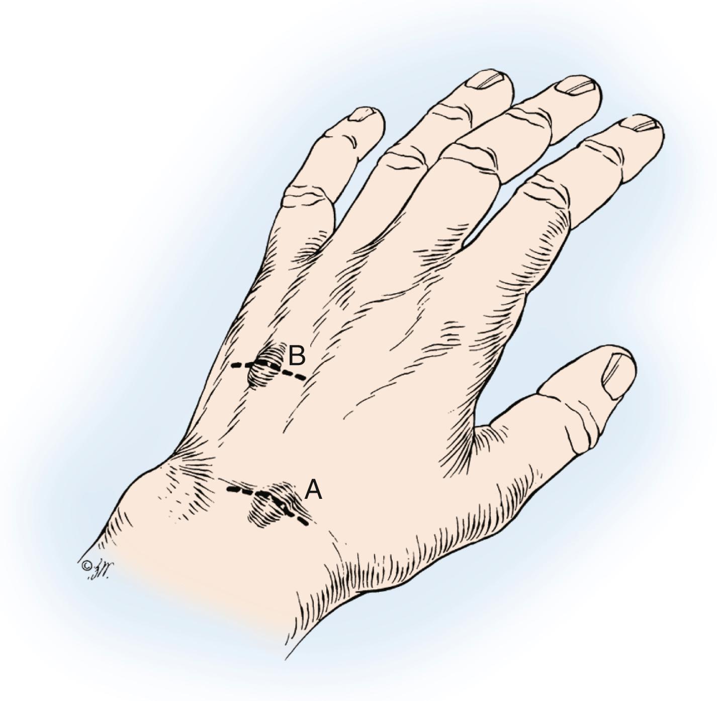 Fig. 59.17, Transverse incision over the scapholunate ligament (A) used to expose the typical dorsal ganglion. An additional incision (B) was made to expose a more distant cyst. The main cyst and pedicle are mobilized, passed under the extensor tendons, and delivered through incision at A.