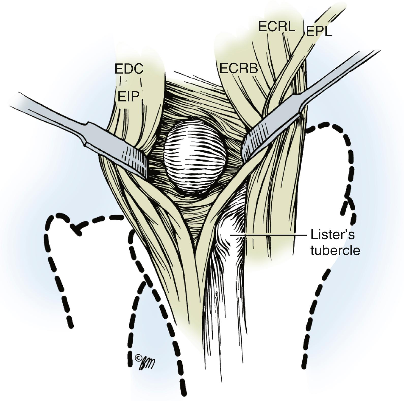 Fig. 59.18, The dorsal ganglion exposed and mobilized between the extensor pollicis longus (EPL), extensor carpi radialis longus (ECRL), and extensor carpi radialis brevis (ECRB) radially and the extensor digitorum communis (EDC) and extensor indicis proprius (EIP) ulnarly.