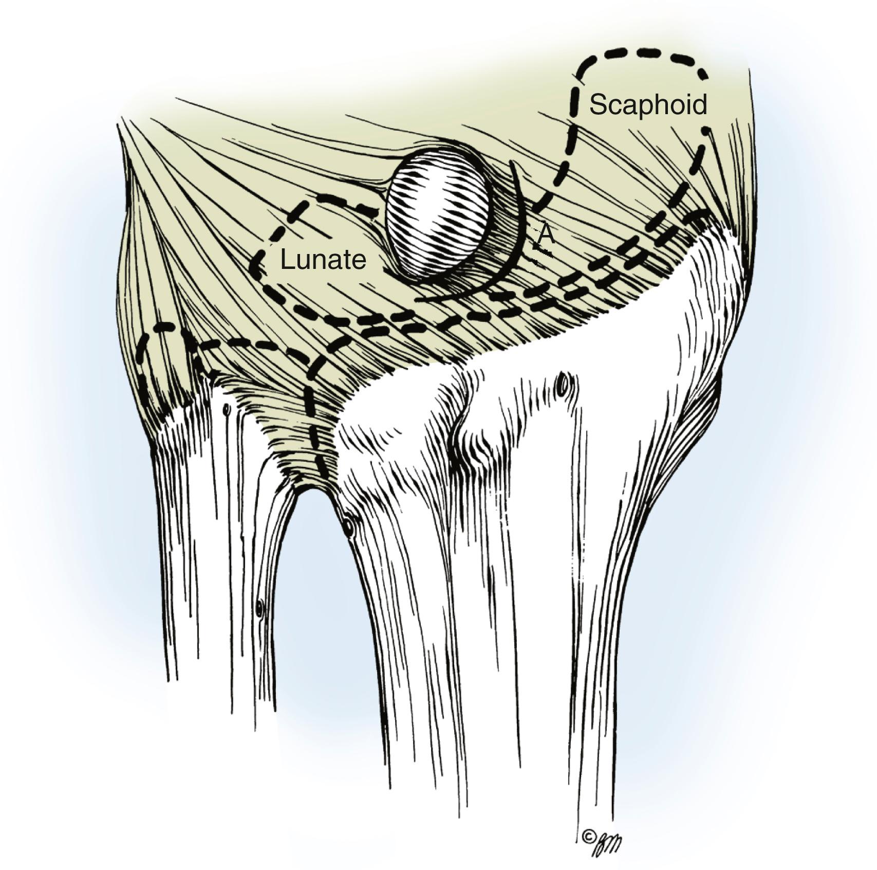 Fig. 59.19, The initial incision through the joint capsule (A) to expose the scapholunate ligament attachments and intracapsular cysts.