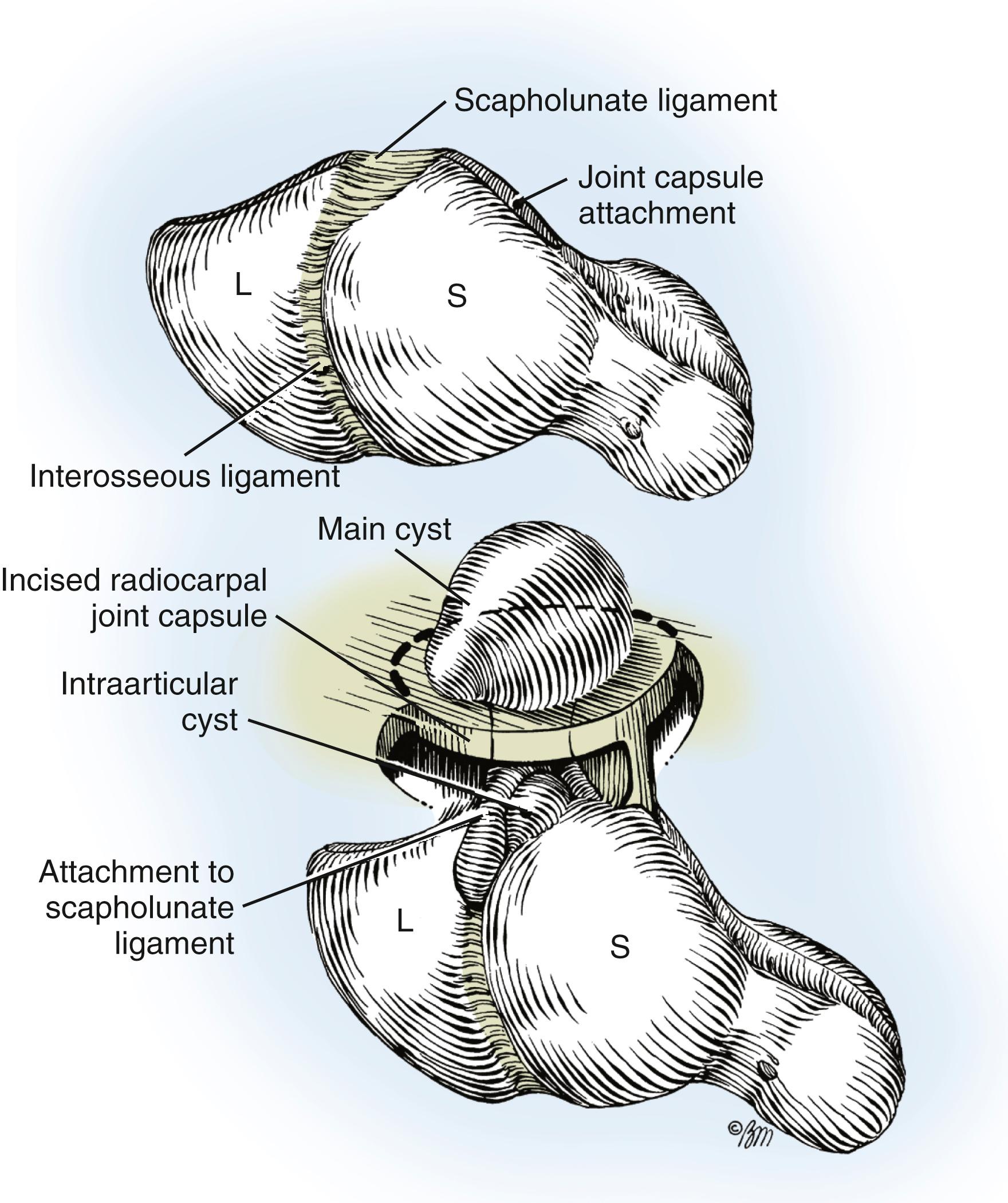 Fig. 59.20, Schematic representation of the cyst in situ. Attachments to the scapholunate ligament are visualized before final excision (dashed line) . L, Lunate; S, scaphoid.