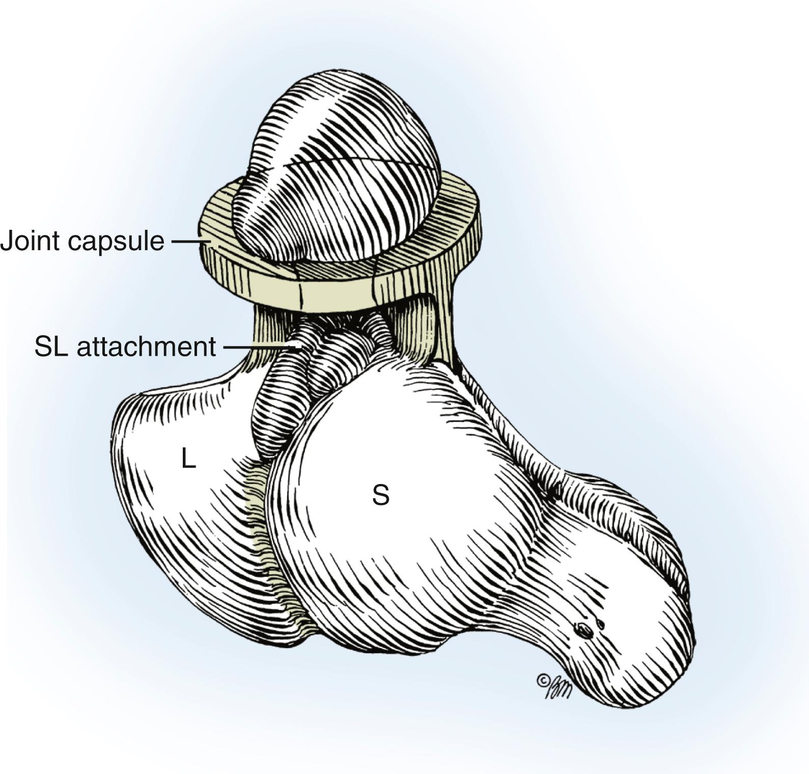 Fig. 59.21, The ganglion and scapholunate (SL) attachments are isolated from the remaining, uninvolved joint capsule (not shown). L, Lunate; S, scaphoid.