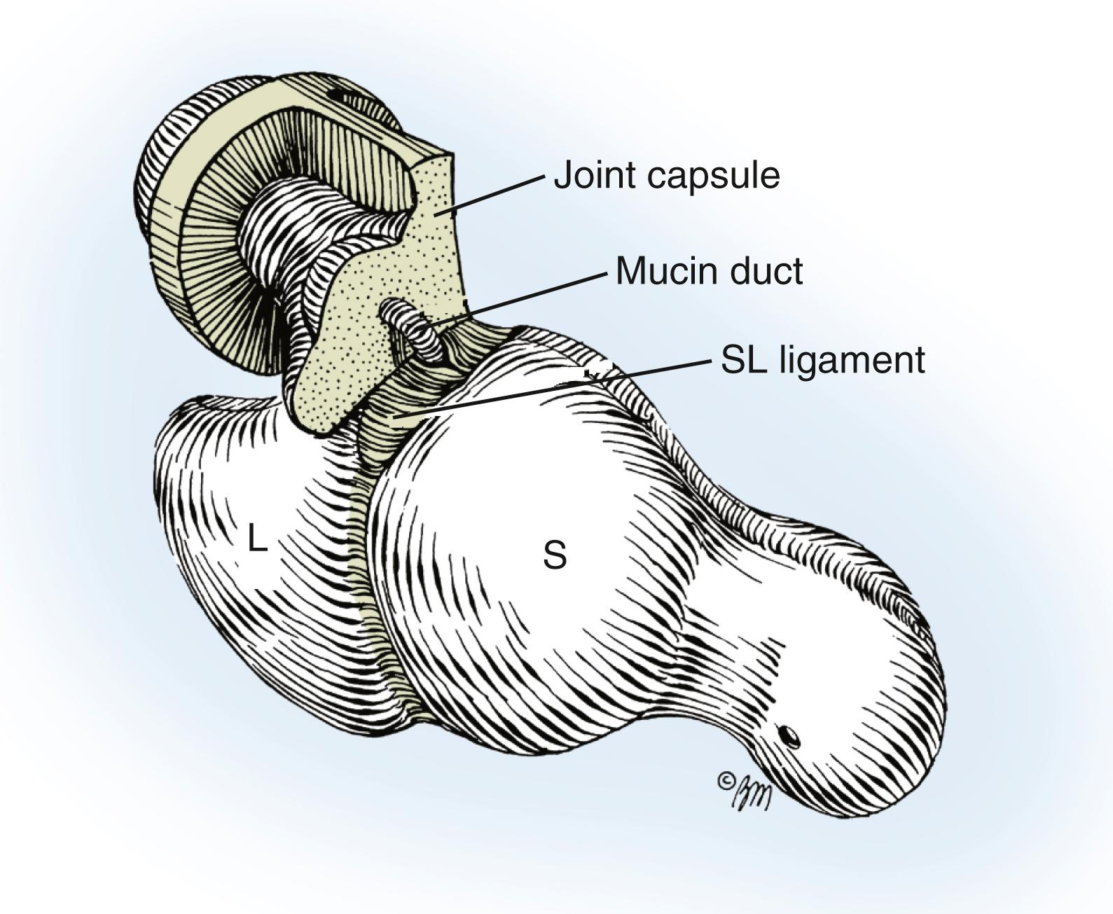 Fig. 59.22, Tangential excision of the ganglion and attachments off the fibers of the scapholunate (SL) ligament. A minute mucin duct piercing the fibers of the SL is invariably cut during this dissection. L, Lunate; S, scaphoid.