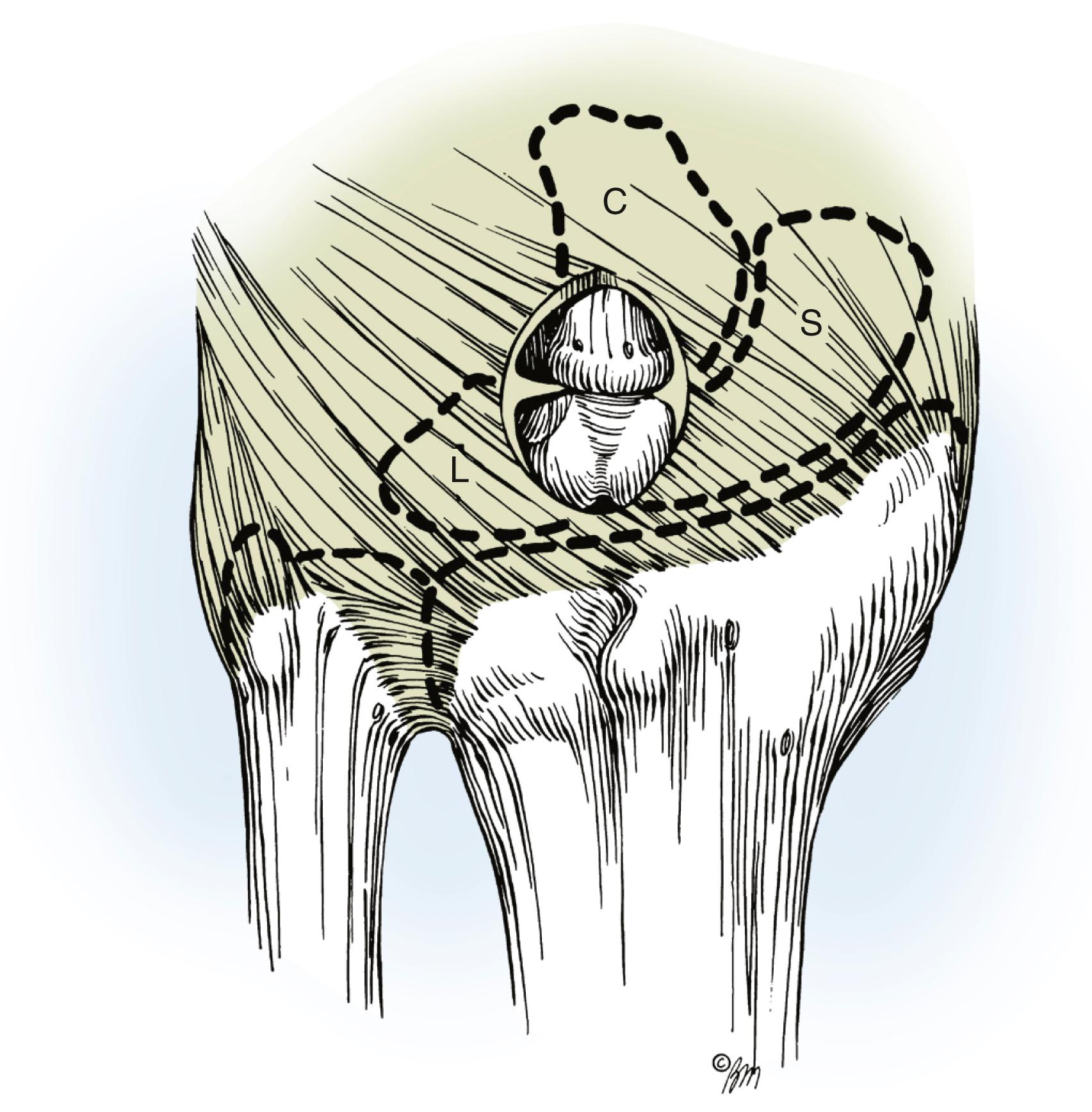 Fig. 59.23, Completed excision of all attachments to the scapholunate (SL) ligament and the immediate vicinity. Synovial tissue between the ligament and the head of the capitate (C) has also been excised. Note that the SLs remain intact. L, Lunate; S, scaphoid.