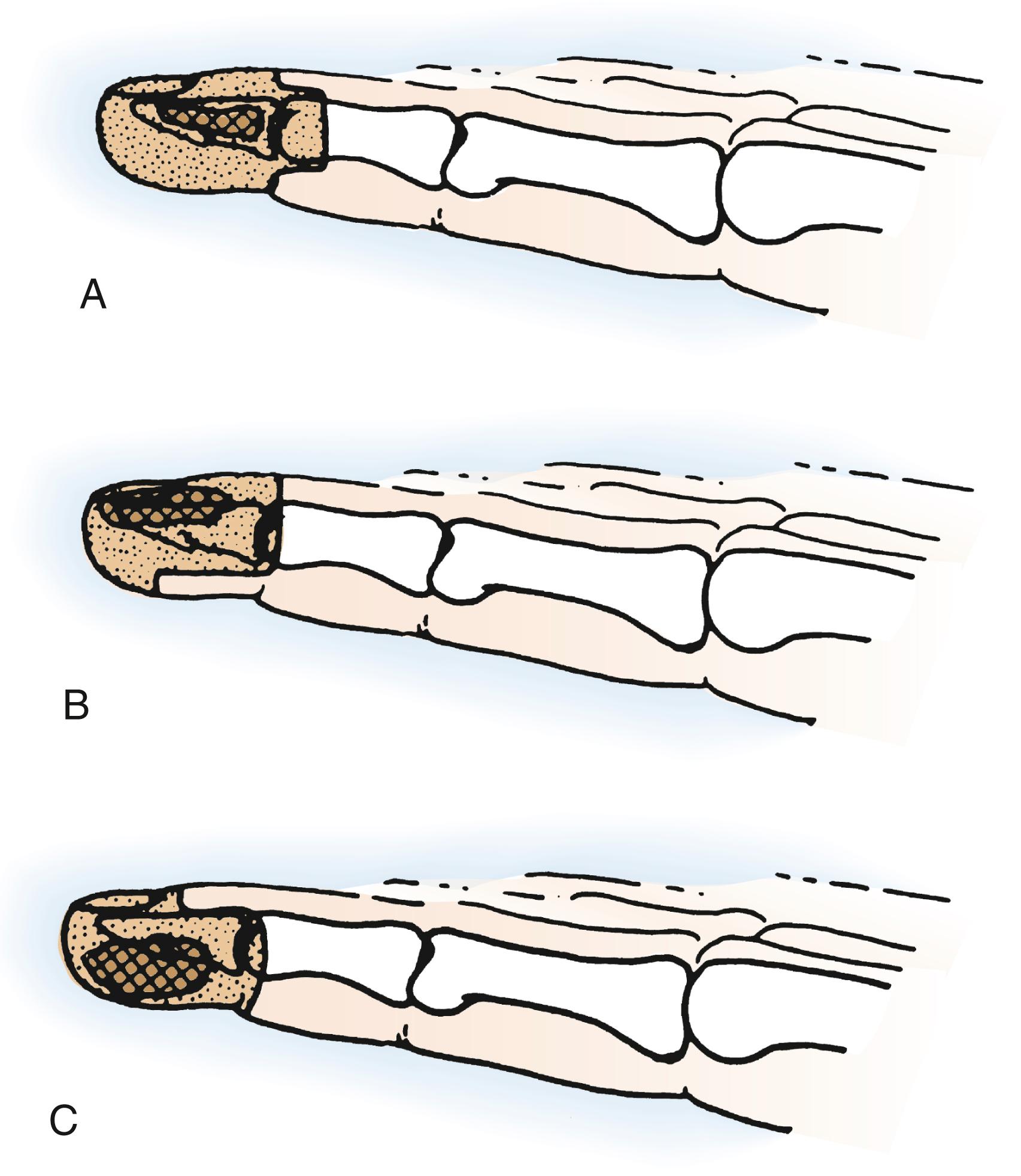 Fig. 59.3, Malignant lesions of the terminal segment of the finger generally require amputation at or proximal to the DIP joint. A, Intraosseous distal phalangeal tumors are amputated at or proximal to the joint along with combined dorsal and volar flap closure. B, Dorsal lesions are treated by appropriate tumor excision with volar flap closure. C, After removal of a palmar tumor, dorsal flap closure may be possible.