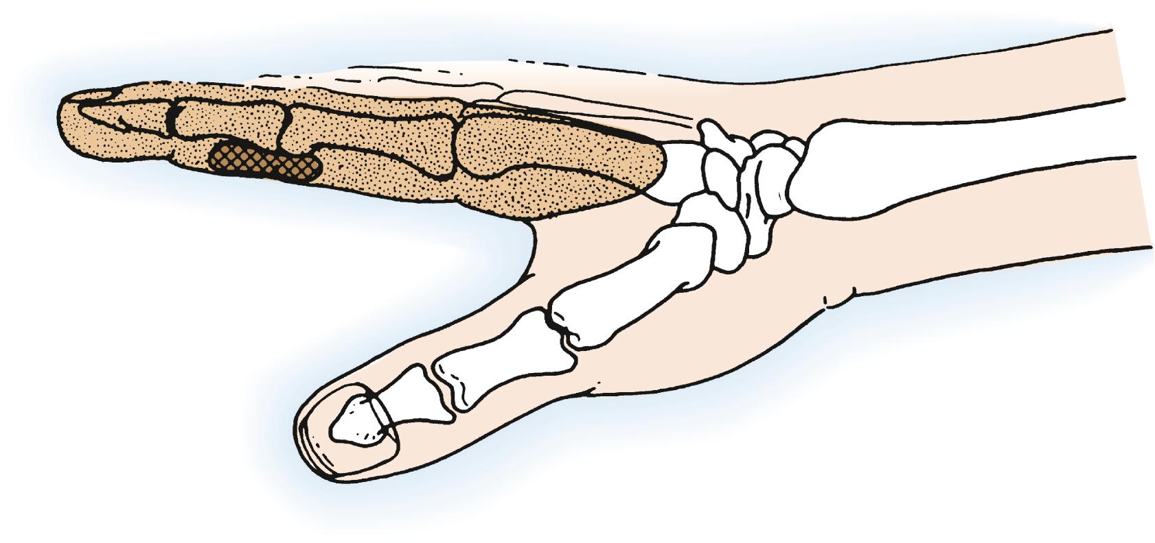 Fig. 59.4, Tumors of soft tissue at the middle phalangeal and proximal interphalangeal joint level are best treated by ray resection.