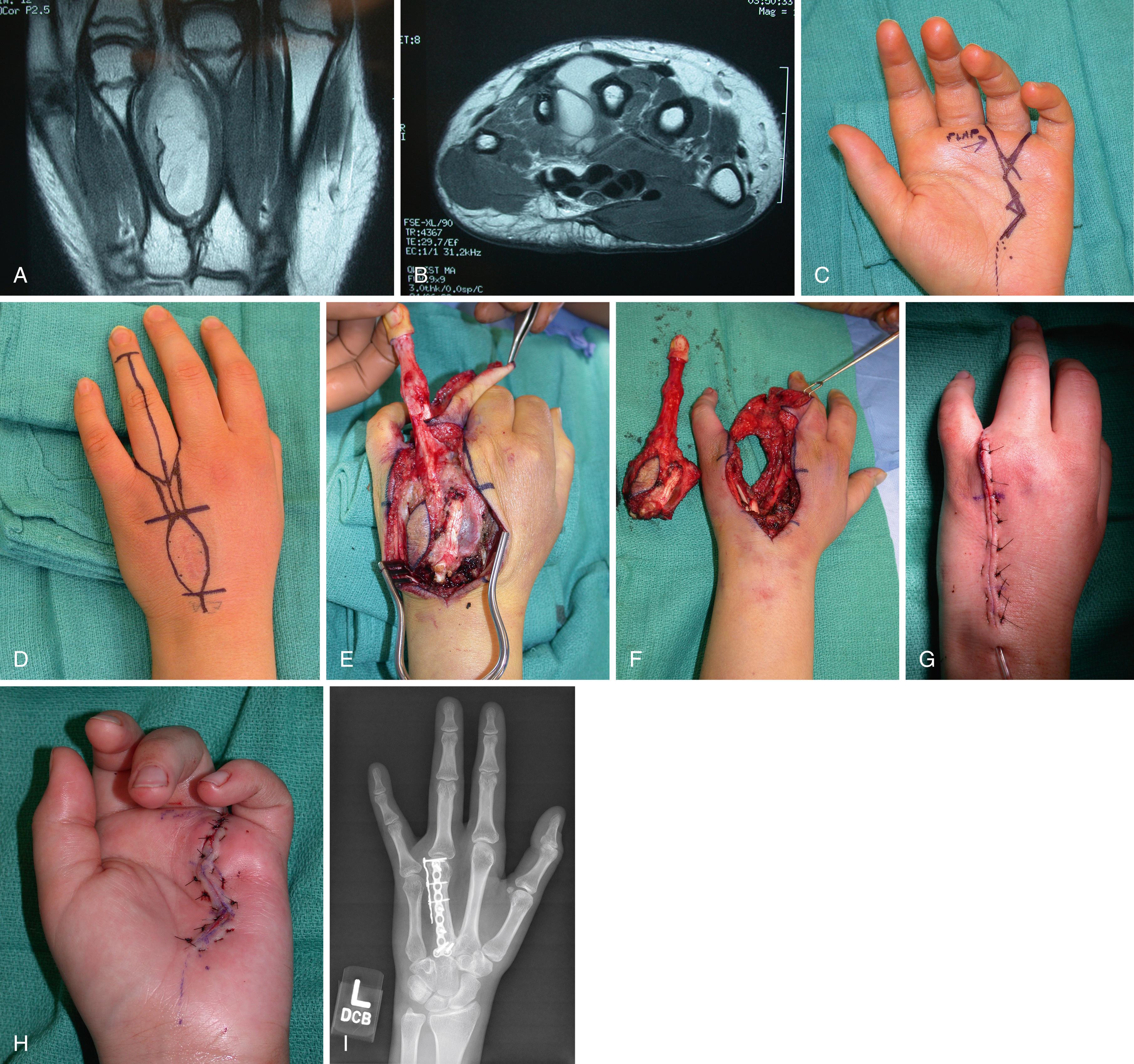 Fig. 59.5, A, Axial magnetic resonance imaging demonstrating synovial sarcoma following radiation involving third and fourth metacarpal. B, Fourth ray resection was performed with en bloc resection of the diaphyseal third metacarpal. C and D, Volar and dorsal incisions for ray amputation and fillet flap marked. Dorsal biopsy tract is incorporated into the dorsal incision. E, F, Intraoperative resection. G and H, Appearance at closure. I, Postoperative radiograph demonstrating third metacarpal reconstruction using fibula graft.