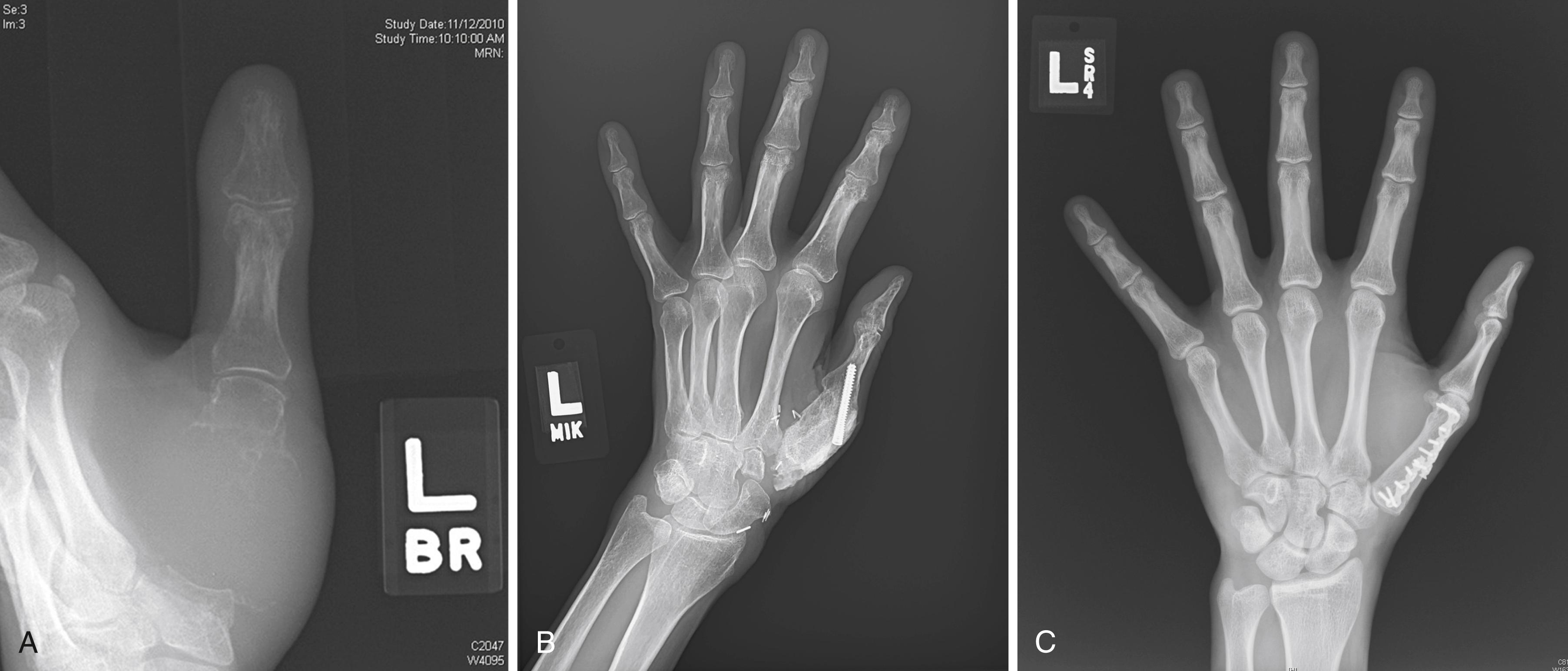 Fig. 59.6, A, A grade 3 giant cell tumor (GCT) of the thumb metacarpal is treated with wide extraarticular resection including the trapezium and base of the proximal phalanx. B, Thumb metacarpal is reconstructed with a large iliac crest graft with metacarpophalangeal joint arthrodesis and proximal suspension. C, Long-term follow-up of diaphyseal segment reconstruction using iliac crest bone graft for a grade 2 chondrosarcoma. Small blade plates facilitate internal fixation of small periarticular fragments.