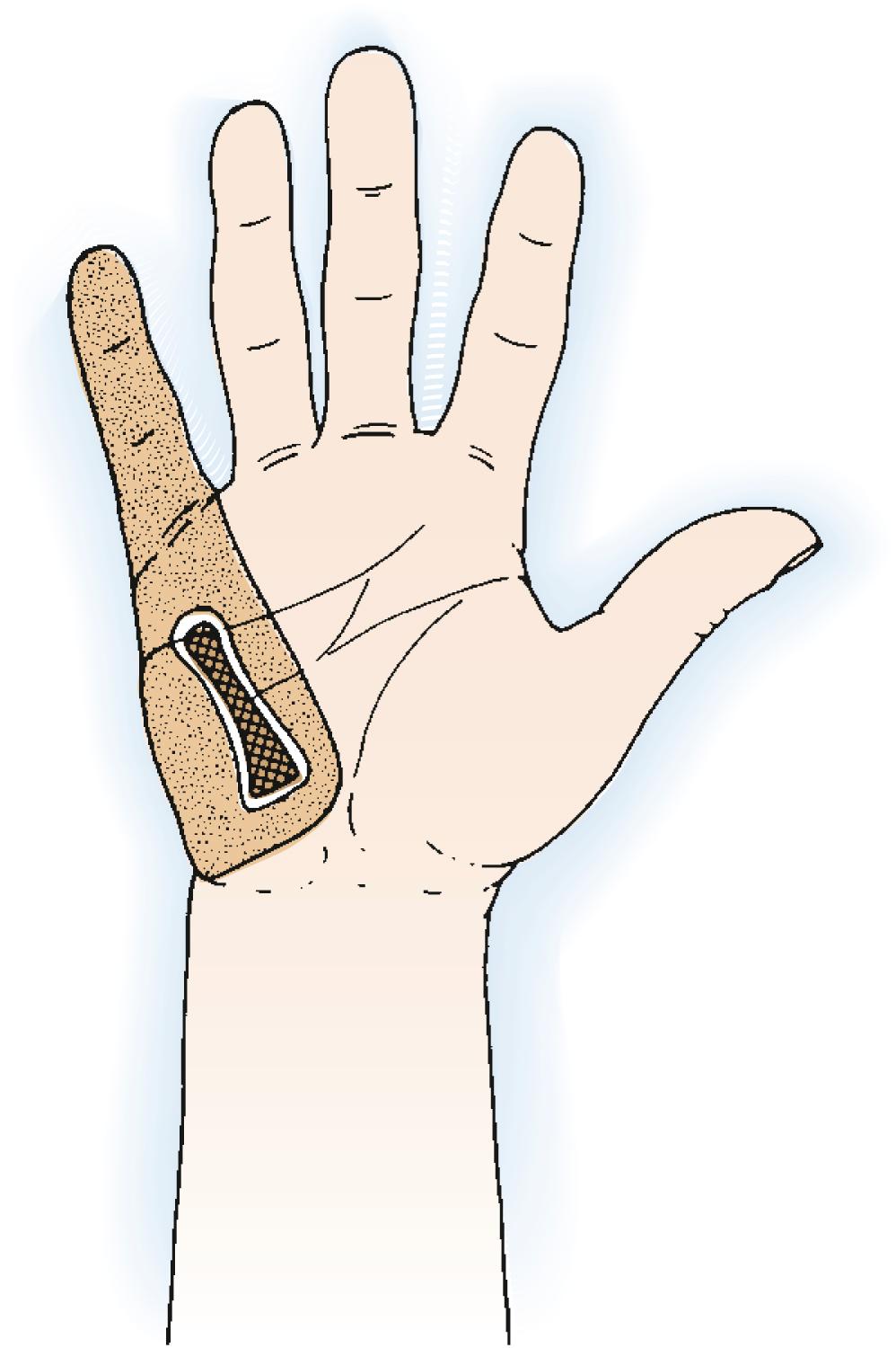 Fig. 59.7, Malignant tumors of the fifth metacarpal can be treated by ray excision.