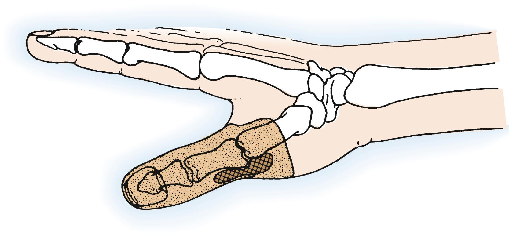 Fig. 59.8, Malignant soft tissue tumors adjacent to the thumb metacarpophalangeal joint require amputation through the metacarpal. More aggressive and extensive tumors may require removal of the entire ray, possibly contiguous with the second metacarpal.