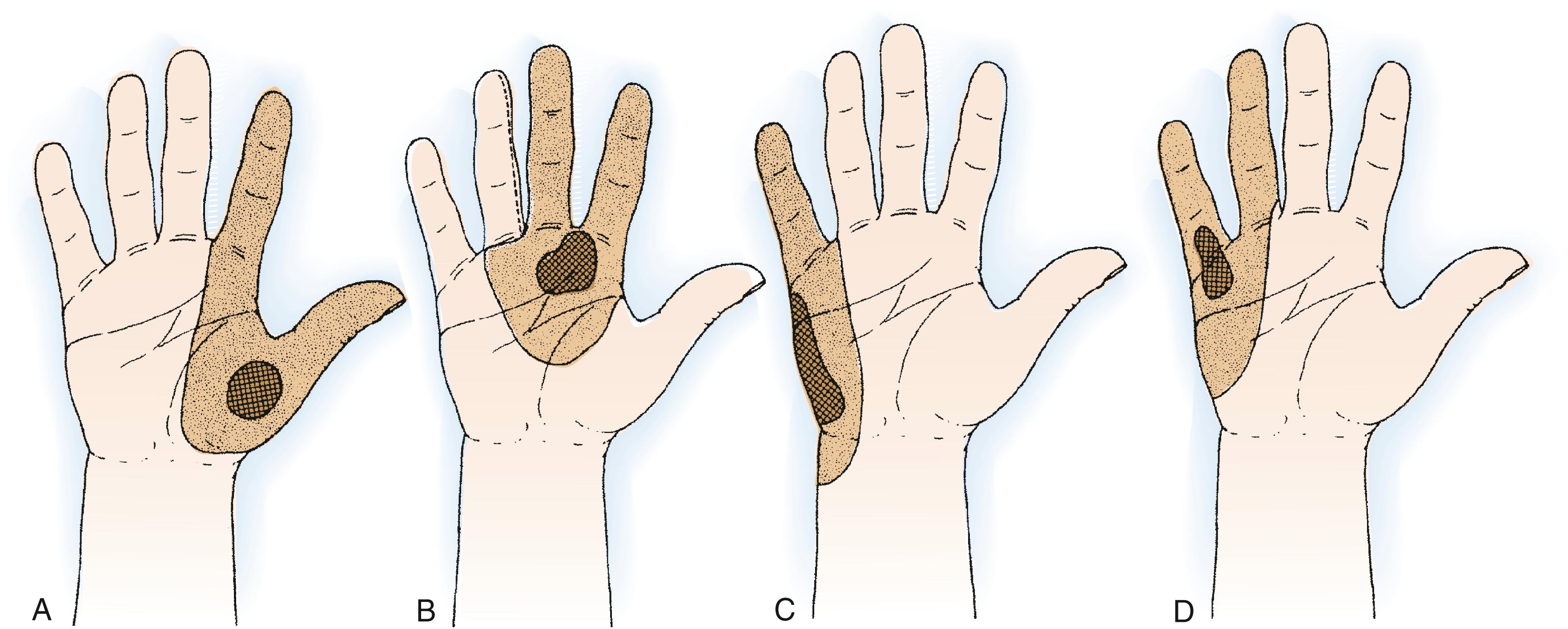 Fig. 59.9, A, Tumors located between the first and second metacarpals may require amputation of both rays for adequate local control. B, Tumors between the second and third metacarpals require removal of both rays. C, Lesions of the ulnar border of the hand can be treated by resection of the fifth ray and local flap or skin graft closure. D, Large and more aggressive lesions or those extending more radially may need removal of both the fourth and fifth rays.