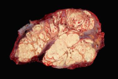 Fig. 2, Tumoral calcinosis.