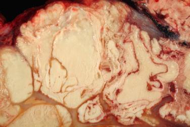 Fig. 3, Tumoral calcinosis.