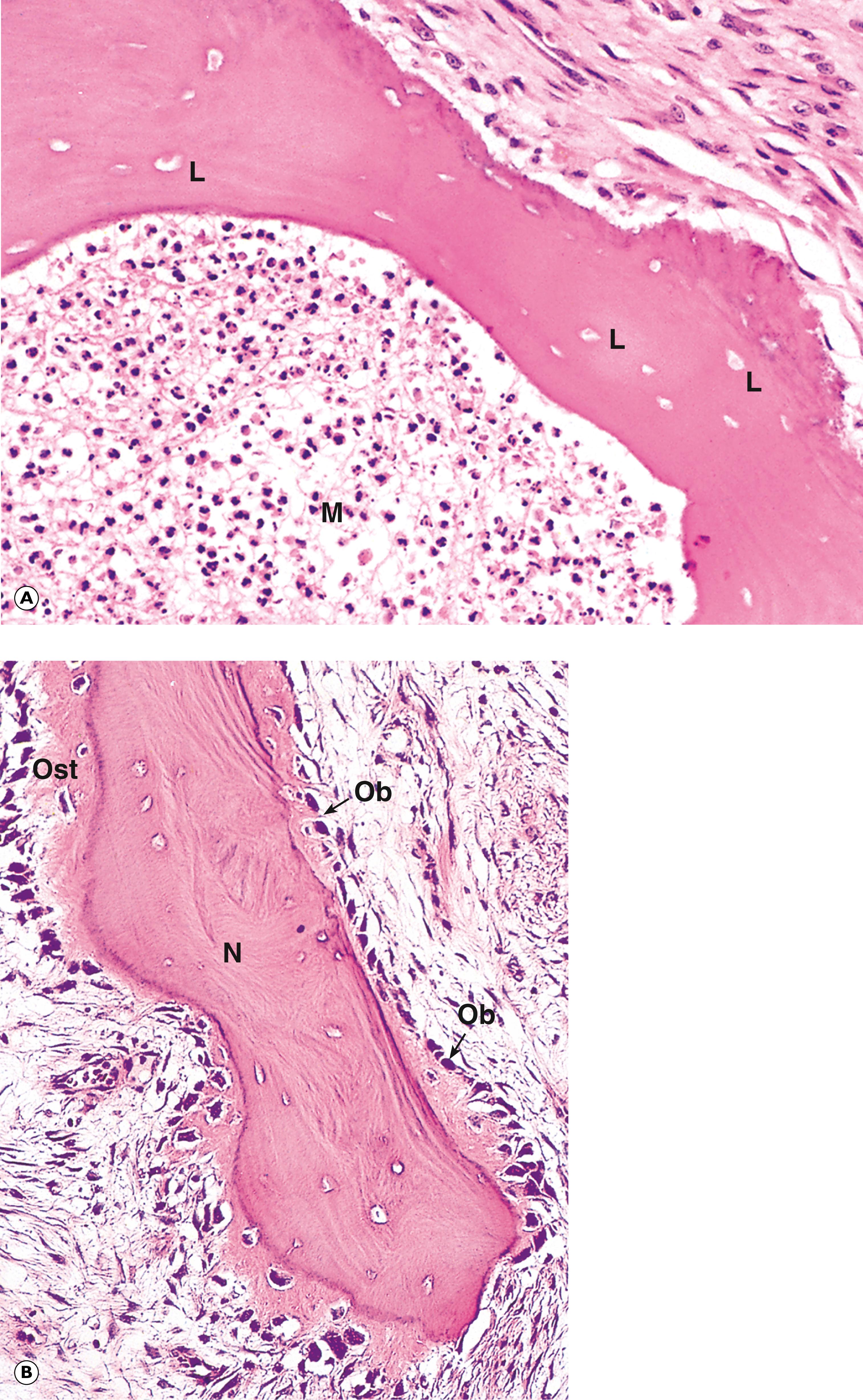 Fig. 22.1, Osteomyelitis. (A) (HP); (B) necrotic bone (HP).