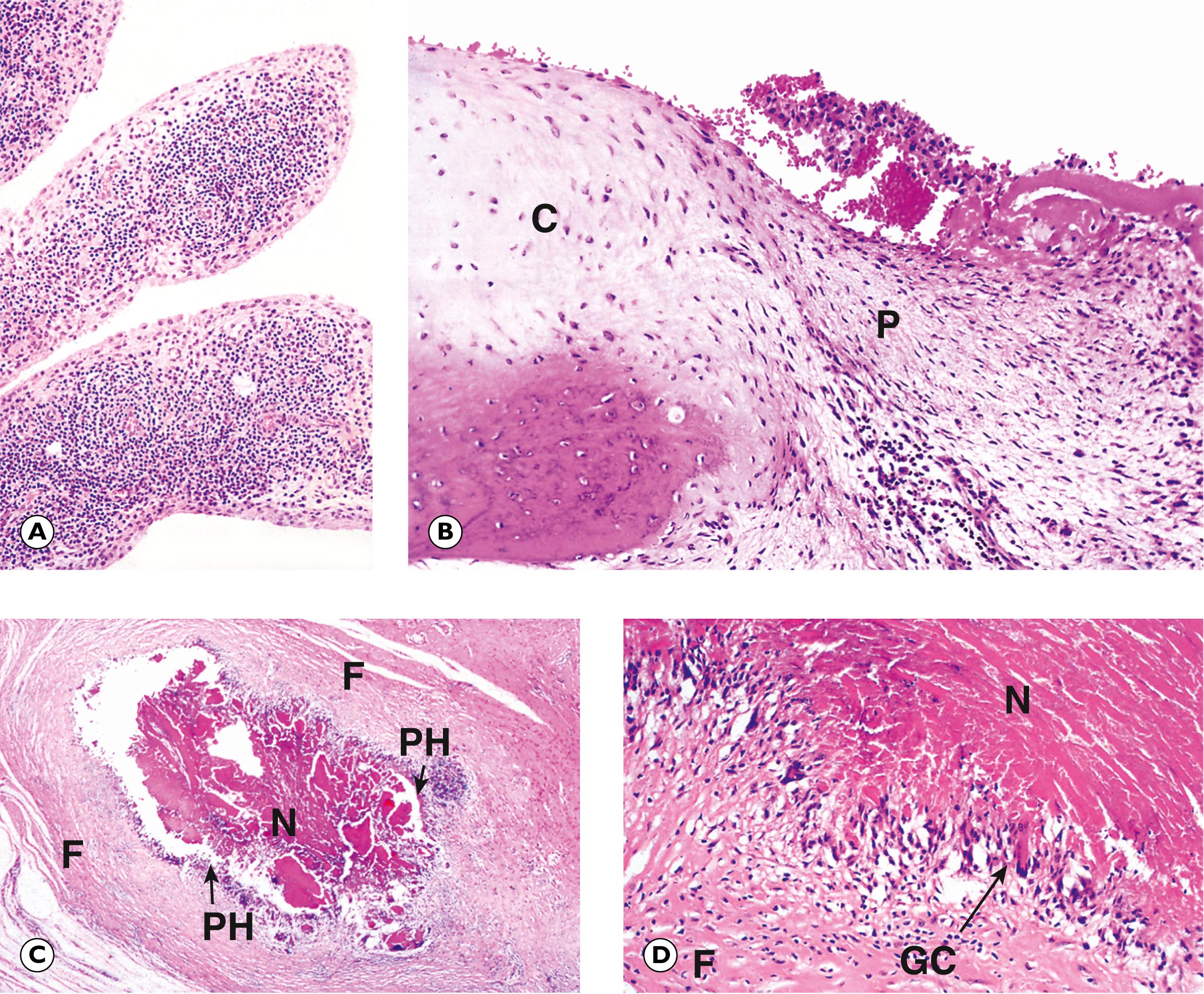 Fig. 22.11, Rheumatoid arthritis. (A) Synovium (MP); (B) articular cartilage (MP); (C) rheumatoid skin nodule (LP); (D) rheumatoid skin nodule (HP).