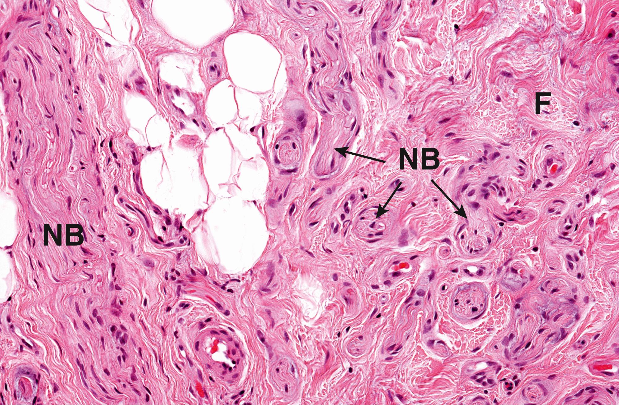 Fig. 22.12, Traumatic neuroma.